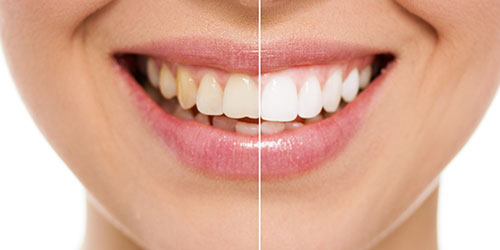 Cosmetic Dentistry before & after