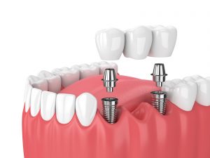 Dental Implant procedure